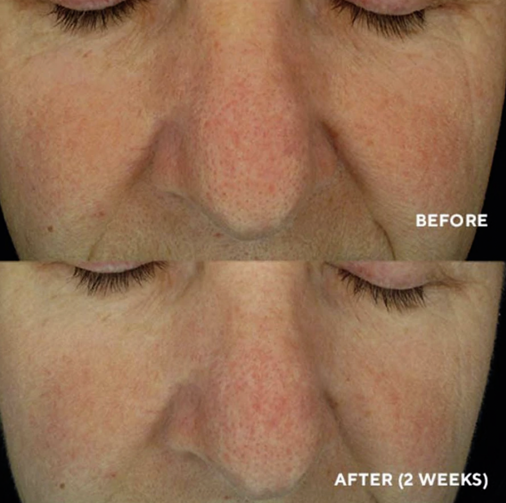 HYDROPEPTIDE SOOTHING SERUM 
Gesichtsserum für empfindliche Haut und Rosazea mit botanischen Stammzellinien und Hyaluronsäure. Mit Wirksamkeit bis auf zellulärer Ebene der DNA