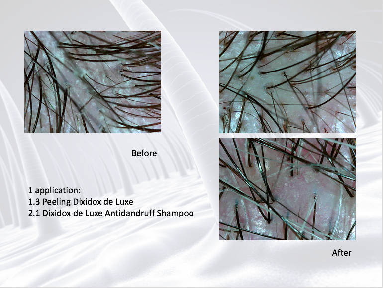 DSD SIMONE DE LUXE ANTIDANDRUFF SHAMPOO 
2.1L ANTI-SCHUPPEN- UND ANTI-HAARAUSFALL-SHAMPOO MIT WACHSTUMSSTIMULIERENDER WIRKUNG