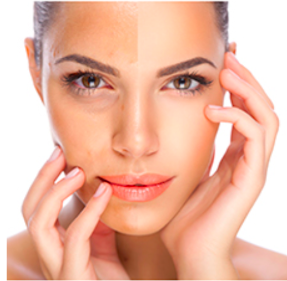 MELAN:OFF protocol MD:Ceuticals 
Depigmentierende Behandlung Videoprotokoll