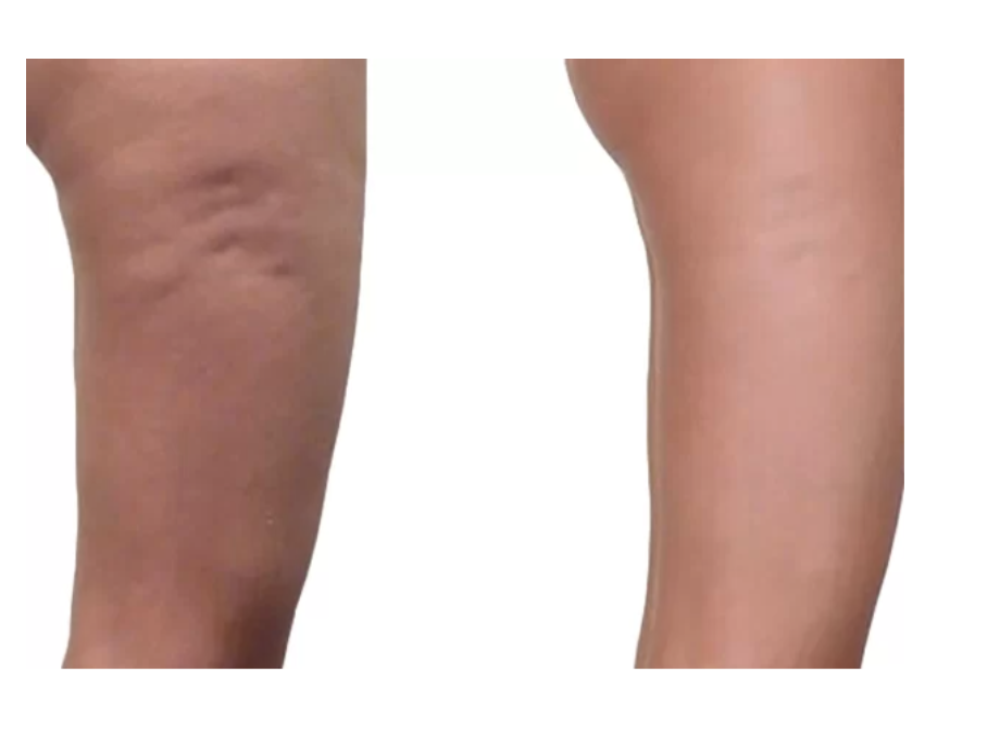 BEAUTYLIZER <br> Anti-Cellulite-Gerät <br> Lymphdrainage und smartes Body-Sculpting 