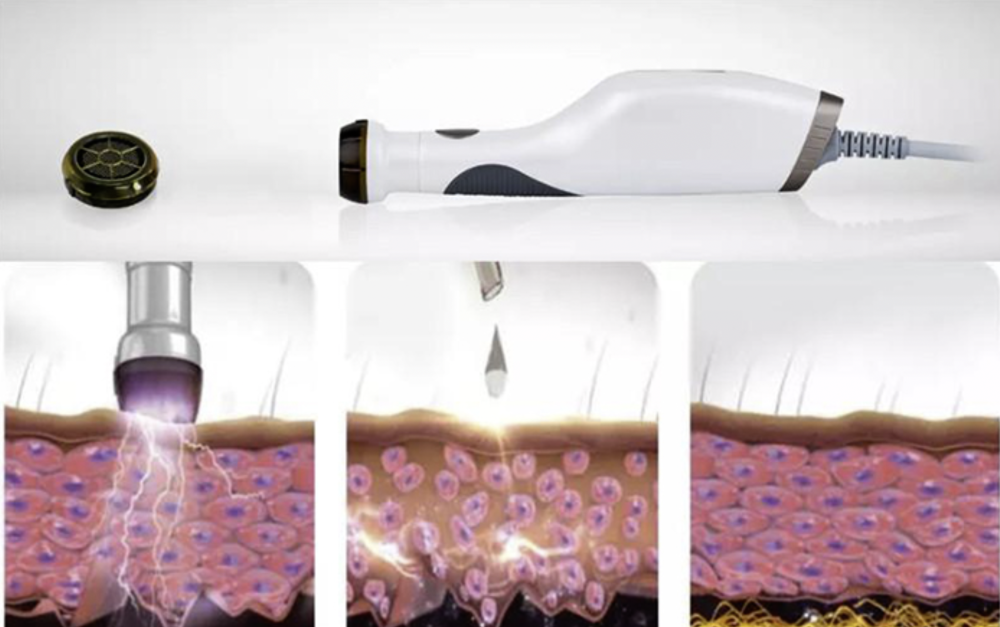 PLASON A PLASMA SHOWER <br> Kosmetikgerät mit Plasmastrahl <br> Löst Hautprobleme mit Plasma und Ultraschall