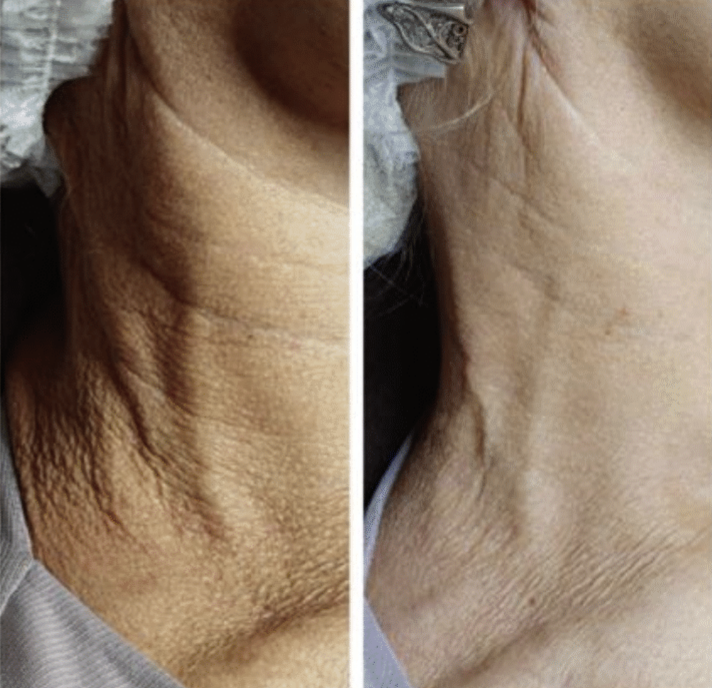 1 PCS VITARAN HP CELL 2x2 ml. +<br>2 PCS VITARAN HP SKIN BOOSTER 2x2 ml. 
Innovativer gewebestimulator mit Polynukleotiden aus Lachs 20 mg/ml (pn) + <br>Skin Booster aus Lachs und Hyaluronsäure zur Verjüngung, Regeneration und Hydratation alternder