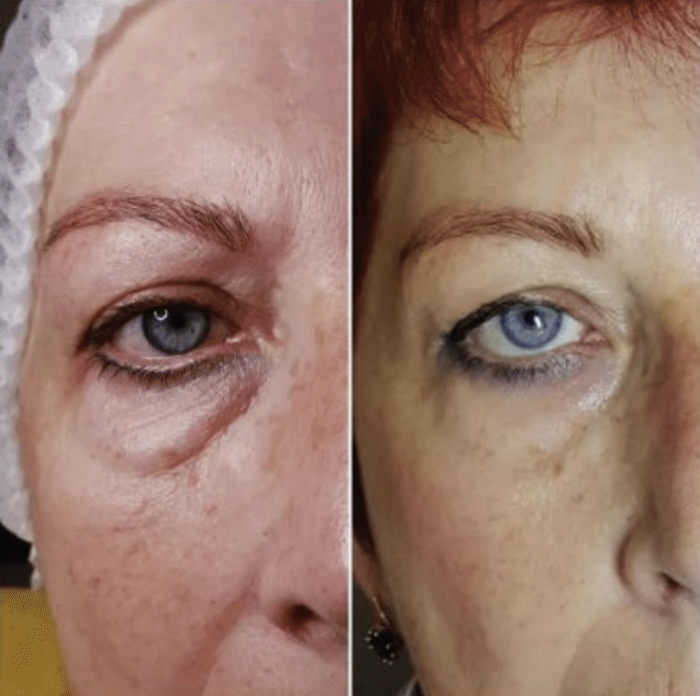 1 PCS VITARAN HP CELL 2x2 ml. +<br>2 PCS VITARAN HP SKIN BOOSTER 2x2 ml. 
Innovativer gewebestimulator mit Polynukleotiden aus Lachs 20 mg/ml (pn) + <br>Skin Booster aus Lachs und Hyaluronsäure zur Verjüngung, Regeneration und Hydratation alternder