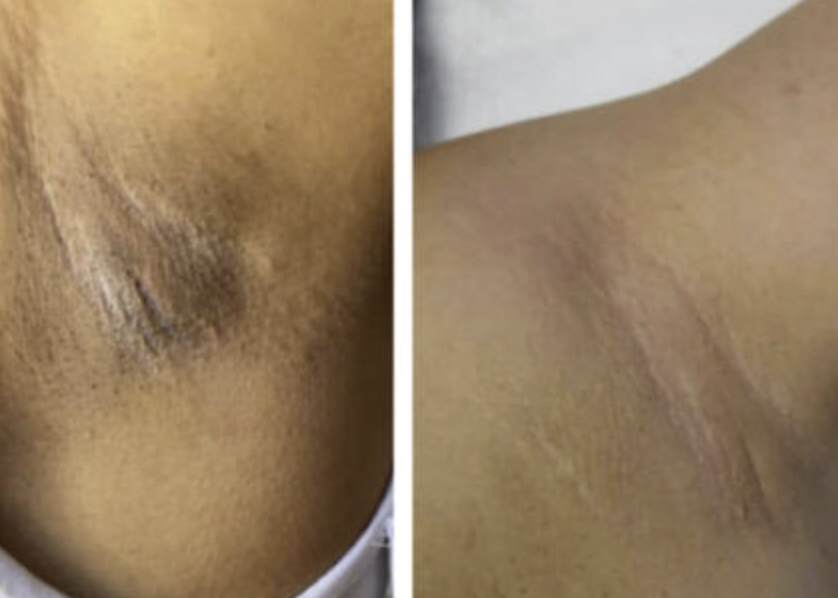 MD:Peel Intimate White<br>MD:Peel aufhellendes und straffendes Peeling für den Intimbereich