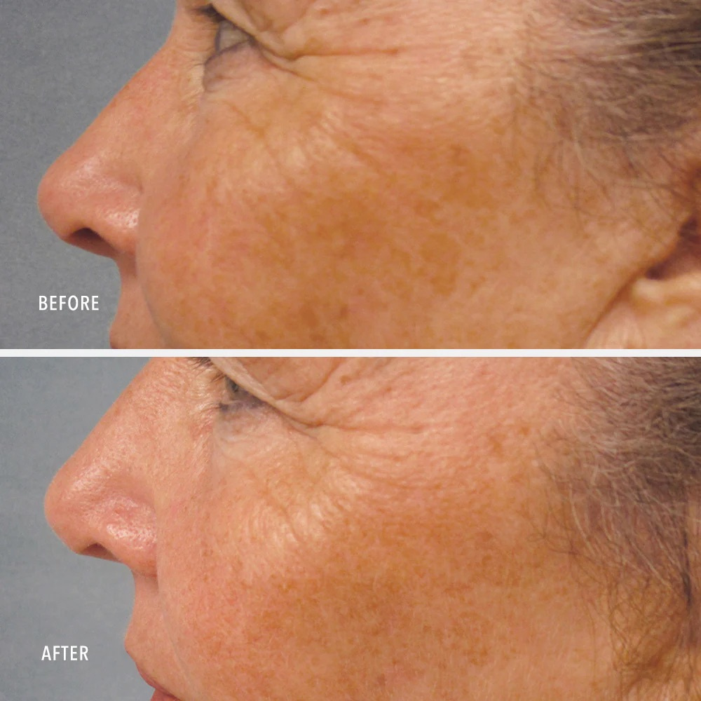 HYDROPEPTIDE LUMAPRO C SERUM 
Gesichtsserum gegen Pigmentflecken mit dem Patent DermalRX SRC für Aufhellung, Hydratation, Pflege der Haut und zur Vorbeugung der Entstehung neuer Flecken.