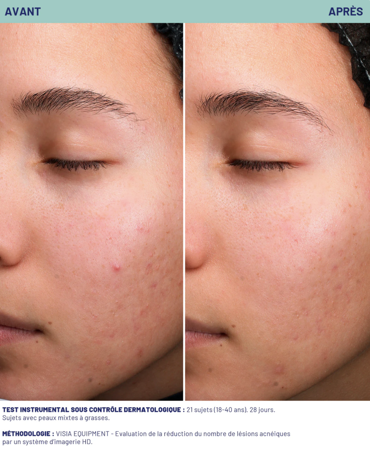 SOSKIN AKN STOP IMPERFECTION SERUM 
Hautschäden behebendes Serum